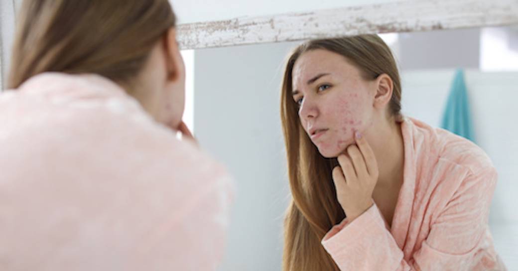 Replay de la conférence  : Les causes de l'acné & quelques pistes pour y remédier -